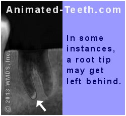 X-ray showing root tip fragment left after an extraction.