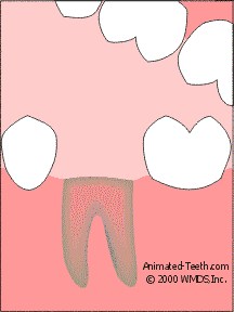 Animation illustrating the placement of gauze directly over the tooth's socket, then applying firm pressure.