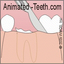 Animation illustrating the creation of a gum tissue flap so a broken tooth can be extracted.