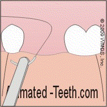 Animation illustrating placing stitches to stabilize a gum tissue flap.
