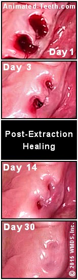 Pictures showing the stages of tooth extraction site healing over time (1 to 4 weeks).