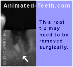 X-ray showing a situation where a surgical extraction may be needed to remove a broken root tip.