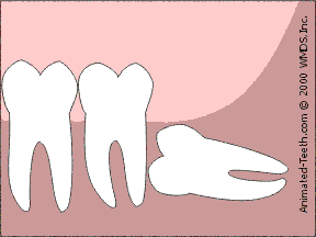 Animation illustrating the sectioning of an Impacted wisdom tooth.