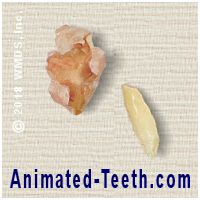 Close up picture of a post-extraction bone sequestrum and tooth fragment.