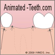 An illustration of a gum tissue flap stitched back into place.