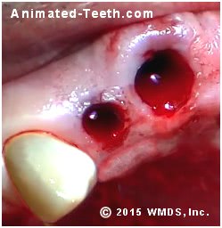 Picture of two tooth sockets, immediately after extraction.