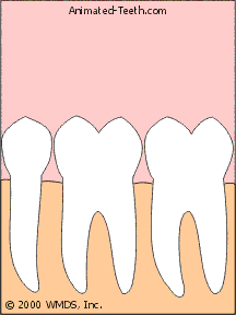 Animation illustrating how a multi-rooted teeth might be sectioned into parts.