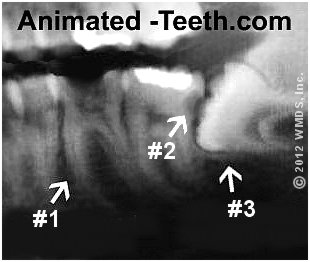 X-ray that reveals multiple teeth require dental work.