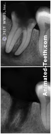 Pre and postoperative x-rays of tooth extraction.