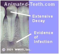 A picture of an infected tooth slated for extraction.