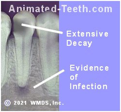 X-ray of a decayed bicuspid that shows signs of associated infection.