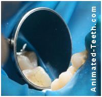 Picture of 2 teeth isolated by a rubber dam ready for dental sealant placement.