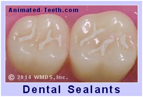 Picture of two teeth that have dental sealants.
