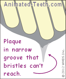Animation showing why deep tooth grooves that can't be effectively brushed should be sealed.