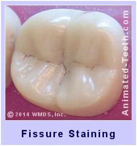 Picture of deep tooth fissures that have accumulated stain.
