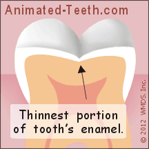 Animation illustrating how a sealant helps to protect against tooth decay.