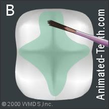 Illustration of a tooth whose surface is being etched with a mild acid in preparation for sealant placement.