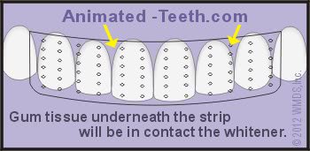 Teeth-whitening strips can cause gum irritation.