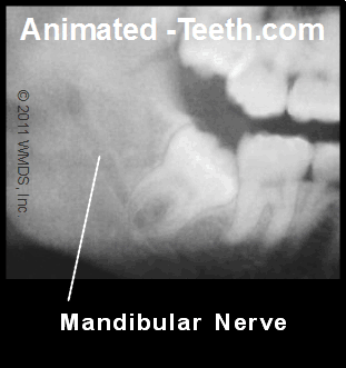 X-ray image showing a good chance of dental paresthesia complications.