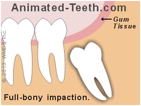 Link to full vs. partial tooth impaction animation.