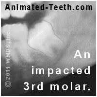 A mesially impacted lower 3rd molar.