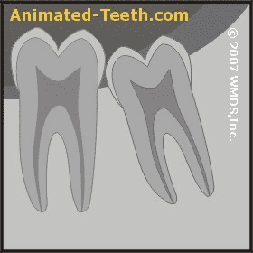 Link to third molar extraction difficulty animation.
