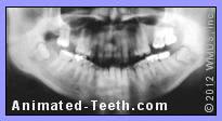 A panoramic dental x-ray showing wisdom teeth.