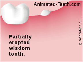Animation showing a partially erupted wisdom tooth.