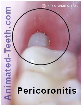 Pericoronitis around a lower wisdom tooth.