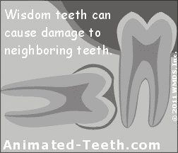 Impacted wisdom teeth can cause root resorption on neighboring teeth.