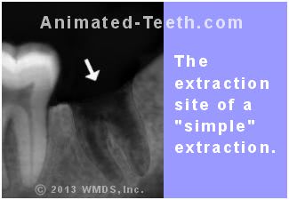 X-ray of the extraction site remaining from a 'simple' extraction.