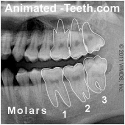 X-ray picture that shows which teeth are the wisdom teeth.