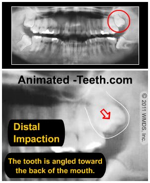 X-ray image of a distal-type wisdom tooth impaction.