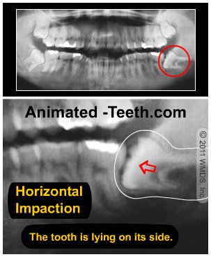 X-ray image of a horizontal-type wisdom tooth impaction.