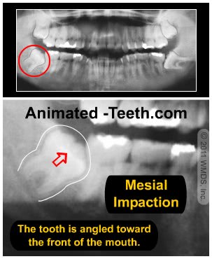 X-ray image of a mesial-type wisdom tooth impaction.