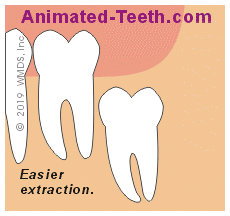 Link to wisdom tooth positioning animation.