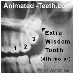 An x-ray showing a 4th molar (an extra wisdom tooth).