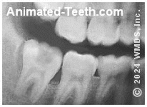 Dental X-ray showing wisdom tooth cavity.