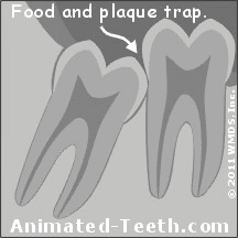 Impacted wisdom teeth can help cause tooth decay on neighboring teeth.