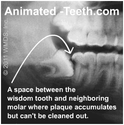 Tooth decay between a wisdom tooth and 2nd molar.