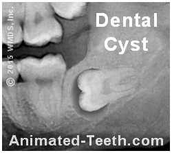A dental cyst associated with an impacted wisdom tooth.