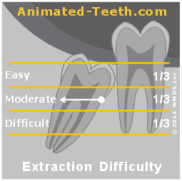 The depth of the wisdom tooth is compared to the neighboring 2nd molar.
