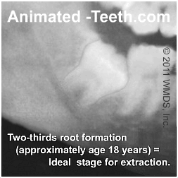 X-ray image showing how full root formation can make an extraction more difficult.