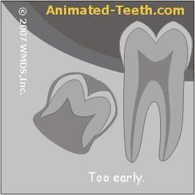 It is usually best to remove impacted wisdom teeth when their roots are only 2/3rds formed.