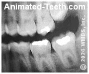 Dental X-ray showing a filling in a wisdom tooth.