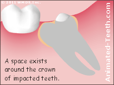 Graphic showing the follicular sac surrounding a partially erupted wisdom tooth.