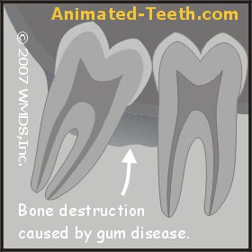 Periodontal disease around the wisdom tooth impacts the 2nd molar.