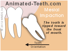 Graphic showing mesial, distal, vertical and horizontal impaction types.