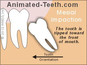A mesially impacted tooth.