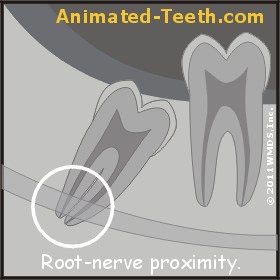 Illustration showing close proximity of a wisdom tooth's root and mandibular nerve.